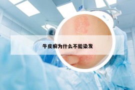 牛皮癣为什么不能染发