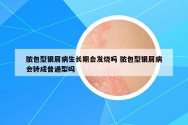 脓包型银屑病生长期会发烧吗 脓包型银屑病会转成普通型吗