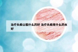 治疗头癣口服什么药好 治疗头癣用什么药水好