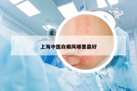 上海中医白癜风哪里最好