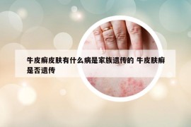 牛皮癣皮肤有什么病是家族遗传的 牛皮肤癣是否遗传