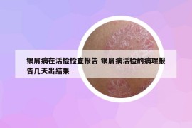 银屑病在活检检查报告 银屑病活检的病理报告几天出结果