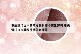 重庆道门口中医院皮肤科哪个医生好啊 重庆道门口皮肤科医院怎么挂号