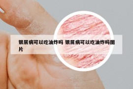 银屑病可以吃油炸吗 银屑病可以吃油炸吗图片