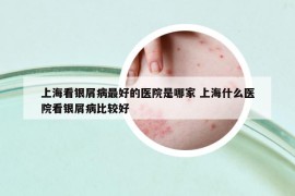 上海看银屑病最好的医院是哪家 上海什么医院看银屑病比较好