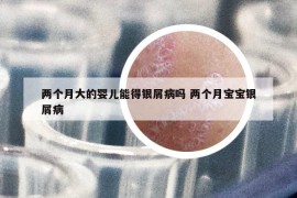 两个月大的婴儿能得银屑病吗 两个月宝宝银屑病