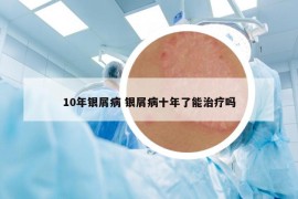 10年银屑病 银屑病十年了能治疗吗