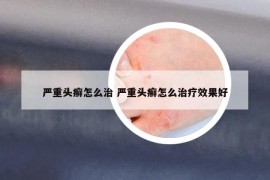 严重头癣怎么治 严重头癣怎么治疗效果好