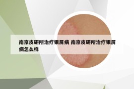 南京皮研所治疗银屑病 南京皮研所治疗银屑病怎么样