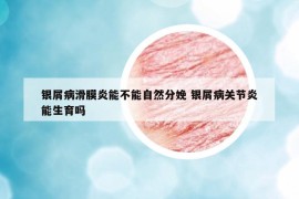 银屑病滑膜炎能不能自然分娩 银屑病关节炎能生育吗