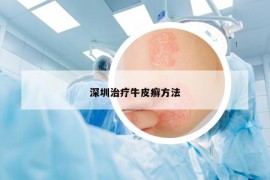 深圳治疗牛皮癣方法