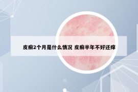 皮癣2个月是什么情况 皮癣半年不好还痒