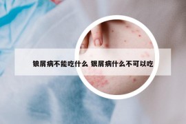 锒屑病不能吃什么 银屑病什么不可以吃