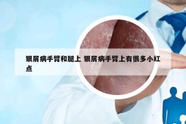 银屑病手臂和腿上 银屑病手臂上有很多小红点