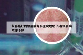 长春最好的银屑病专科医院地址 长春银屑病院哪个好