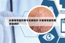 长春哪家医院看牛皮癣较好 长春哪家医院看皮肤病好