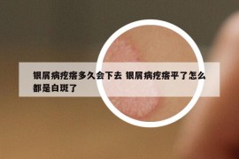 银屑病疙瘩多久会下去 银屑病疙瘩平了怎么都是白斑了