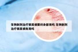 生物制剂治疗银屑病要终身都用吗 生物制剂治疗银屑病有用吗