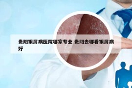 贵阳银屑病医院哪家专业 贵阳去哪看银屑病好