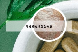 牛皮癣皮损怎么恢复