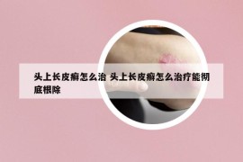 头上长皮癣怎么治 头上长皮癣怎么治疗能彻底根除