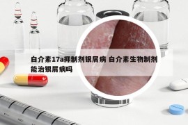 白介素17a抑制剂银屑病 白介素生物制剂能治银屑病吗