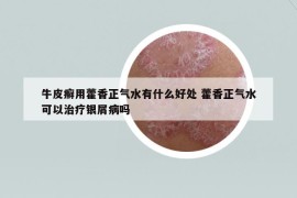 牛皮癣用藿香正气水有什么好处 藿香正气水可以治疗银屑病吗