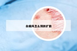 白癜风怎么预防扩散