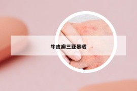 牛皮癣三亚暴晒