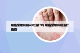 脓疱型银屑病可以治好吗 脓疱型银屑病治疗指南