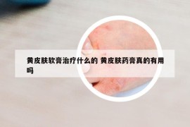 黄皮肤软膏治疗什么的 黄皮肤药膏真的有用吗