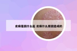 皮癣是因什么起 皮癣什么原因造成的