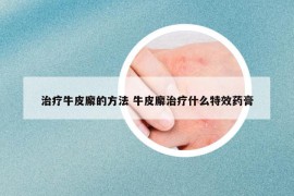 治疗牛皮廨的方法 牛皮廨治疗什么特效药膏