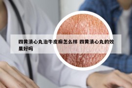 四黄清心丸治牛皮癣怎么样 四黄清心丸的效果好吗