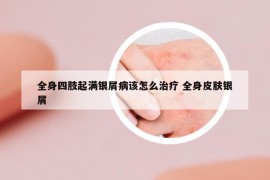 全身四肢起满银屑病该怎么治疗 全身皮肤银屑