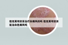 他克莫司软膏治疗白癜风的吗 他克莫司软膏能治白色癜风吗