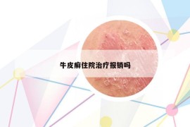 牛皮癣住院治疗报销吗