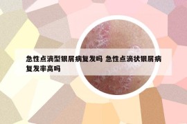 急性点滴型银屑病复发吗 急性点滴状银屑病复发率高吗