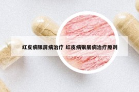 红皮病银屑病治疗 红皮病银屑病治疗原则