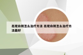 出现白斑怎么治疗方法 出现白斑怎么治疗方法最好