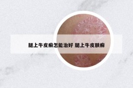 腿上牛皮癣怎能治好 腿上牛皮肤癣