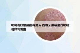 吡琉翁欣银屑病有用么 西班牙原装进口吡硫翁锌气雾剂