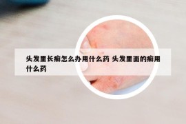 头发里长癣怎么办用什么药 头发里面的癣用什么药