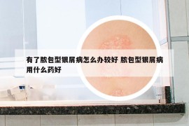 有了脓包型银屑病怎么办较好 脓包型银屑病用什么药好