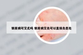 银屑病可艾炙吗 银屑病艾灸可以直接灸患处