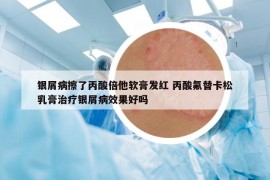 银屑病擦了丙酸倍他软膏发红 丙酸氟替卡松乳膏治疗银屑病效果好吗