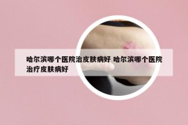 哈尔滨哪个医院治皮肤病好 哈尔滨哪个医院治疗皮肤病好