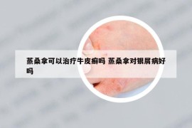 蒸桑拿可以治疗牛皮癣吗 蒸桑拿对银屑病好吗