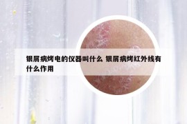 银屑病烤电的仪器叫什么 银屑病烤红外线有什么作用