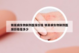 银屑病生物制剂医保价格 银屑病生物制剂医保价格是多少